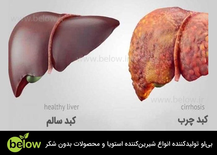 کبد چرب از بیماری های ناشی از چاقی