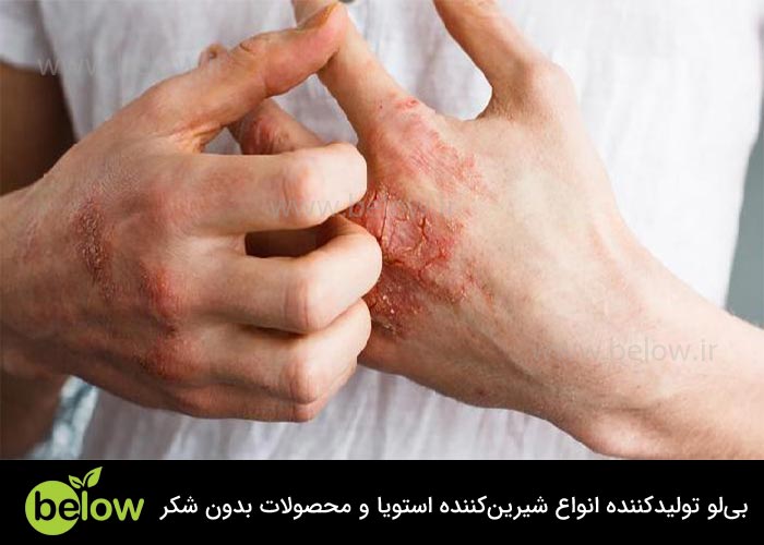 دیابت و خشکی پوست و درمان آن با قند رژیمی