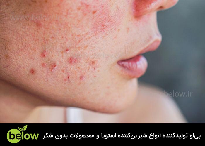 کاهش آکنه پوستی با حذف قند برای زیبایی و پوست