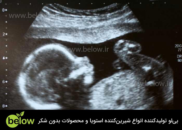 اثرات قند مصنوعی بر خطرات دیابت بارداری